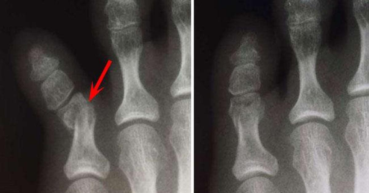 F is for Falls, Fractures and Fighting Through F is for Falls, Fractures and Fighting Through