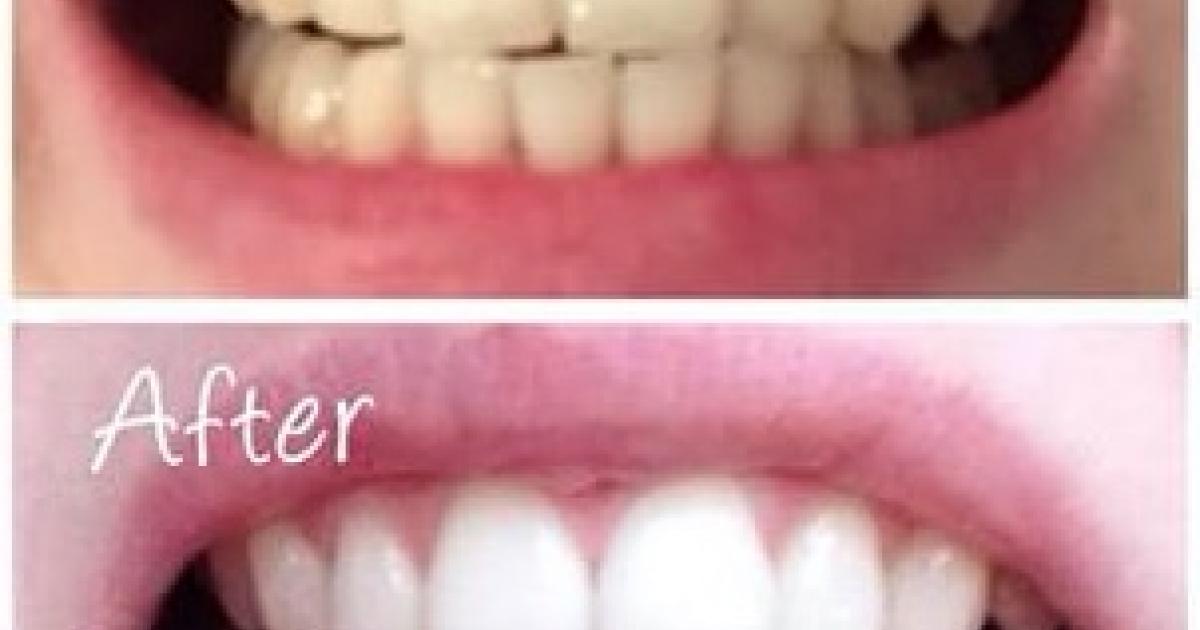 toothpaste that whitens and desensitizes toothpaste that whitens and desensitizes