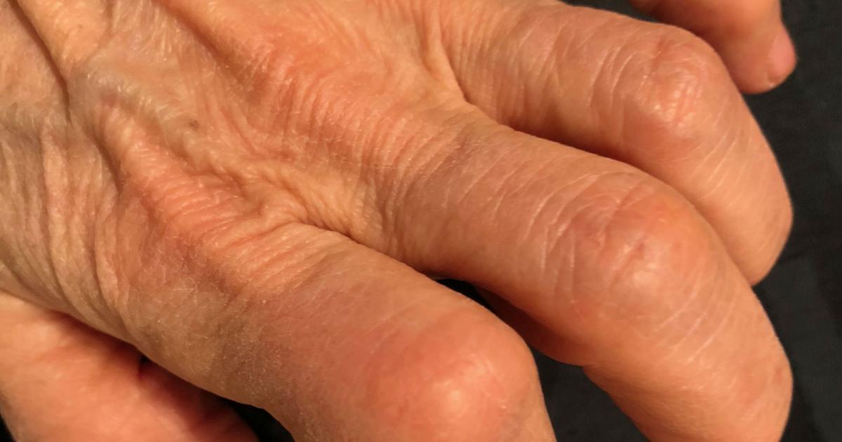 arthritic hand