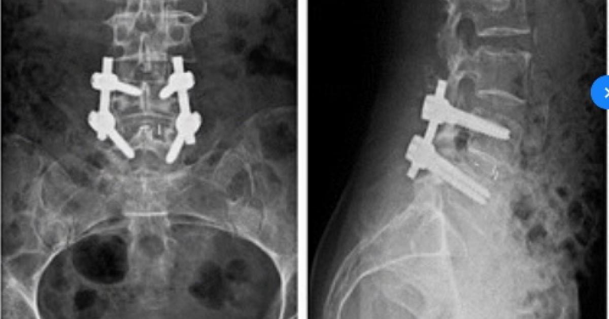 Back surgery Back surgery